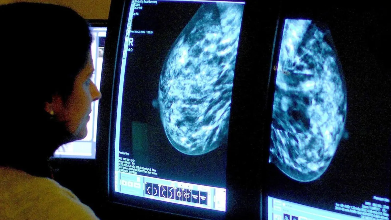 Doctors Read Her Mammogram and Saw Nothing. The AI Saw a Tumor.