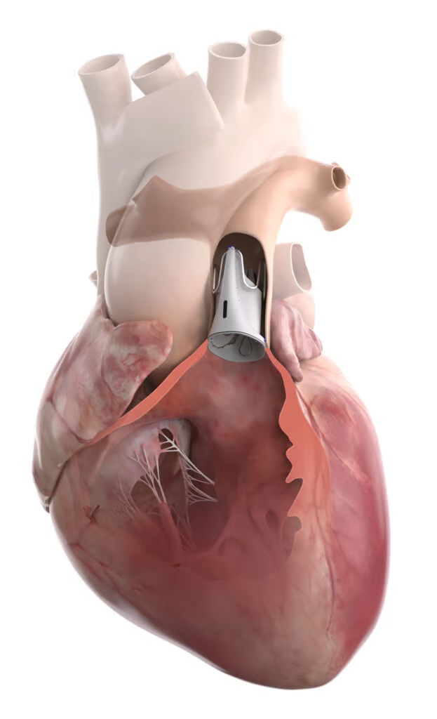 Growth-Accommodating Medtech: How Expandable Scaffolds Disrupt Congenital Surgical Cycles