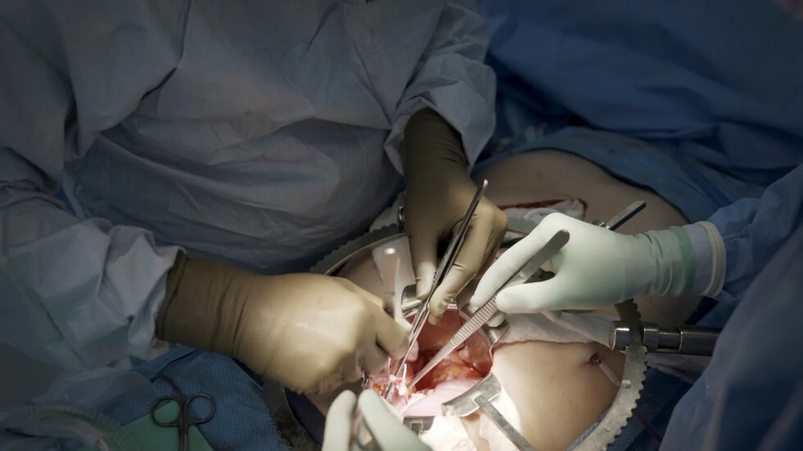 Pig Kidney Transplants Are Now in Human Trials. Here Is What EXPAND and Its Rivals Actually Have to Prove
