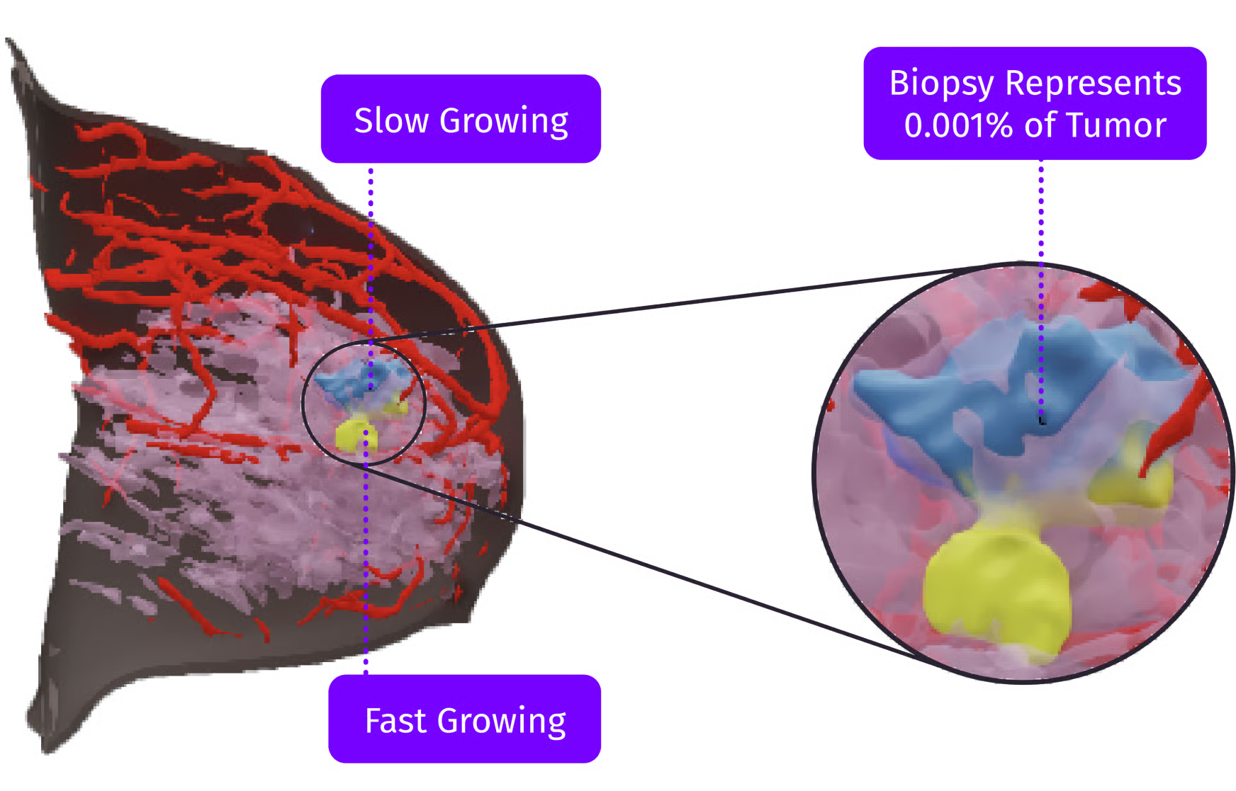 Inside SimBioSys TumorSight Risk: Bringing Recurrence Assessment Into the MRI Workflow