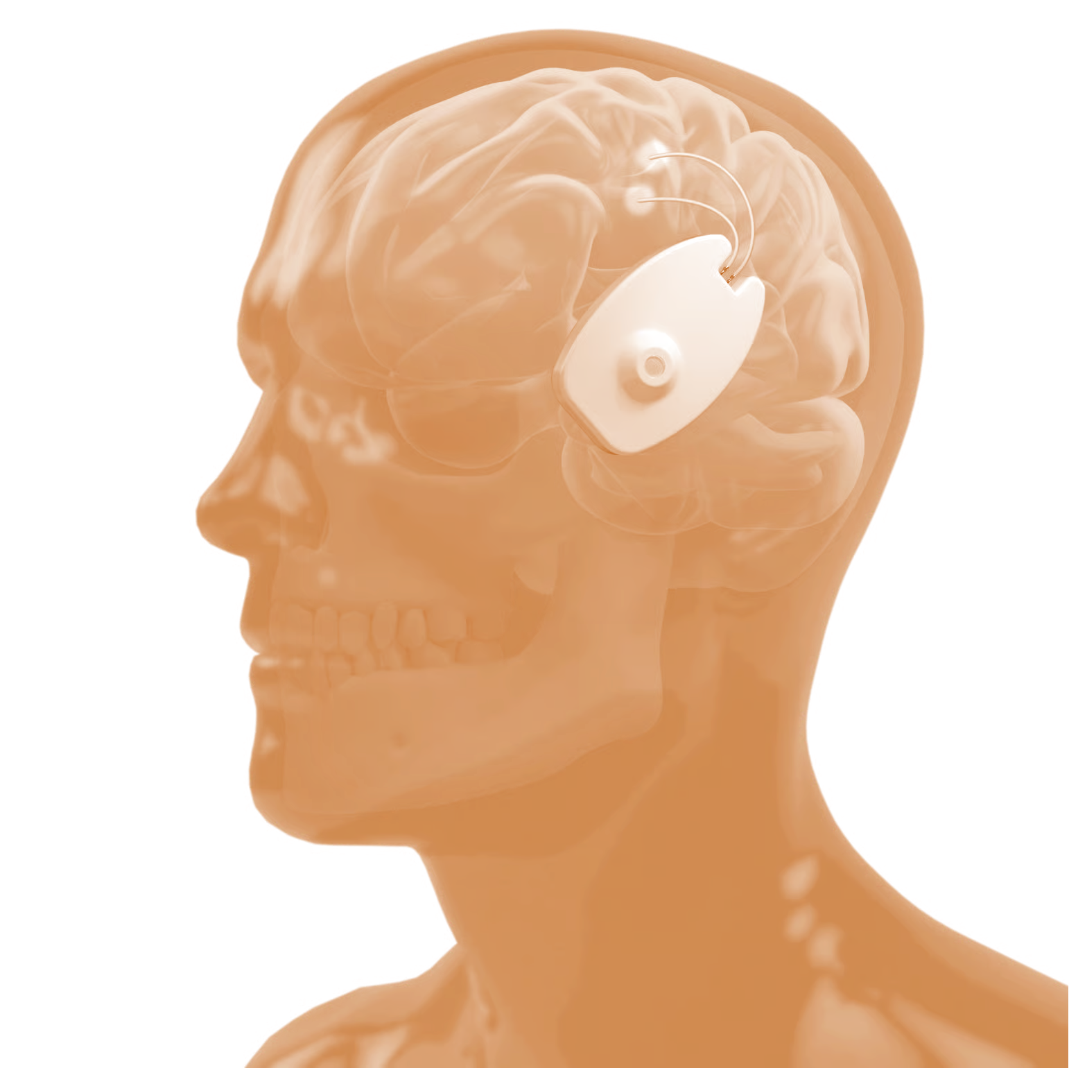 The Skull as Therapeutic Infrastructure: How CraniUS and Chronic Convection Delivery Bypass the Blood-Brain Barrier